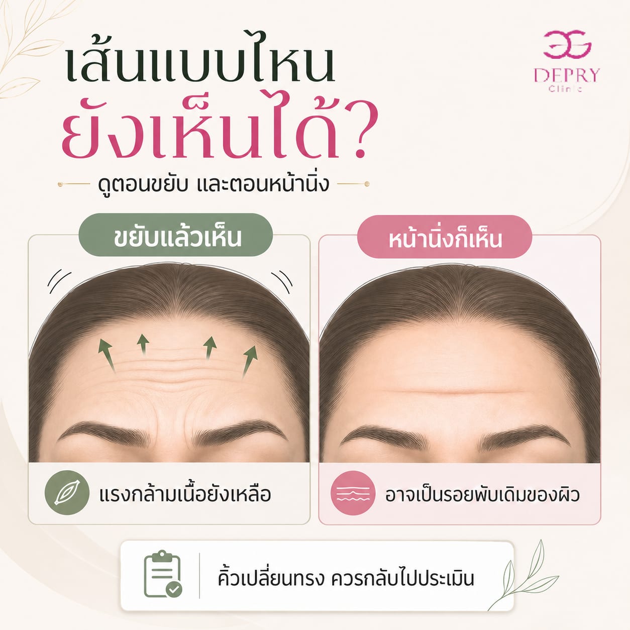 ภาพเปรียบเทียบรอยเหนือคิ้วตอนขยับกับรอยพับที่ยังเห็นตอนหน้านิ่ง