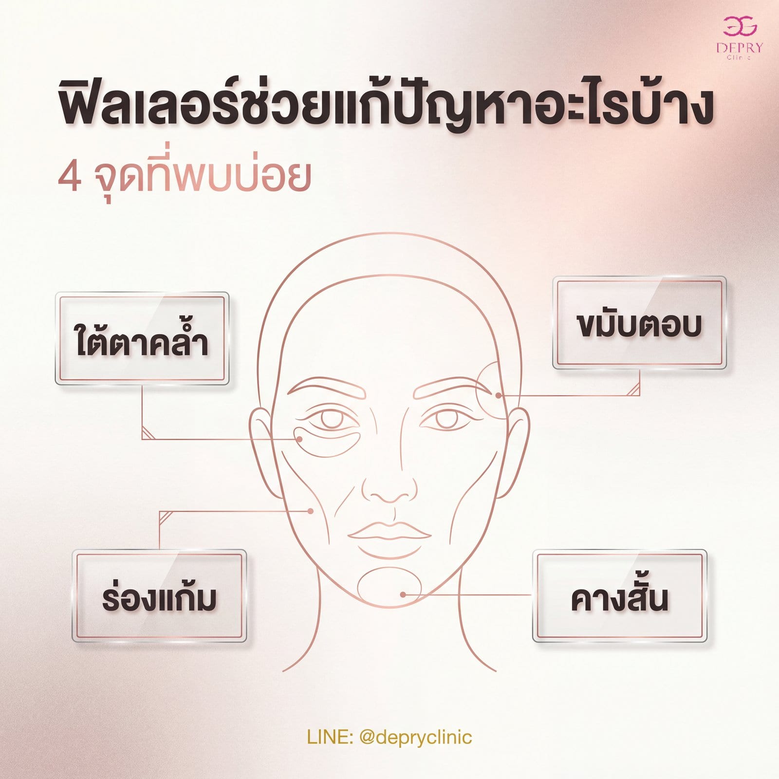 อินโฟกราฟิกสรุป 4 จุดที่ฟิลเลอร์ช่วยแก้ปัญหาได้บ่อย ใต้ตาคล้ำ ขมับตอบ ร่องแก้ม คางสั้น