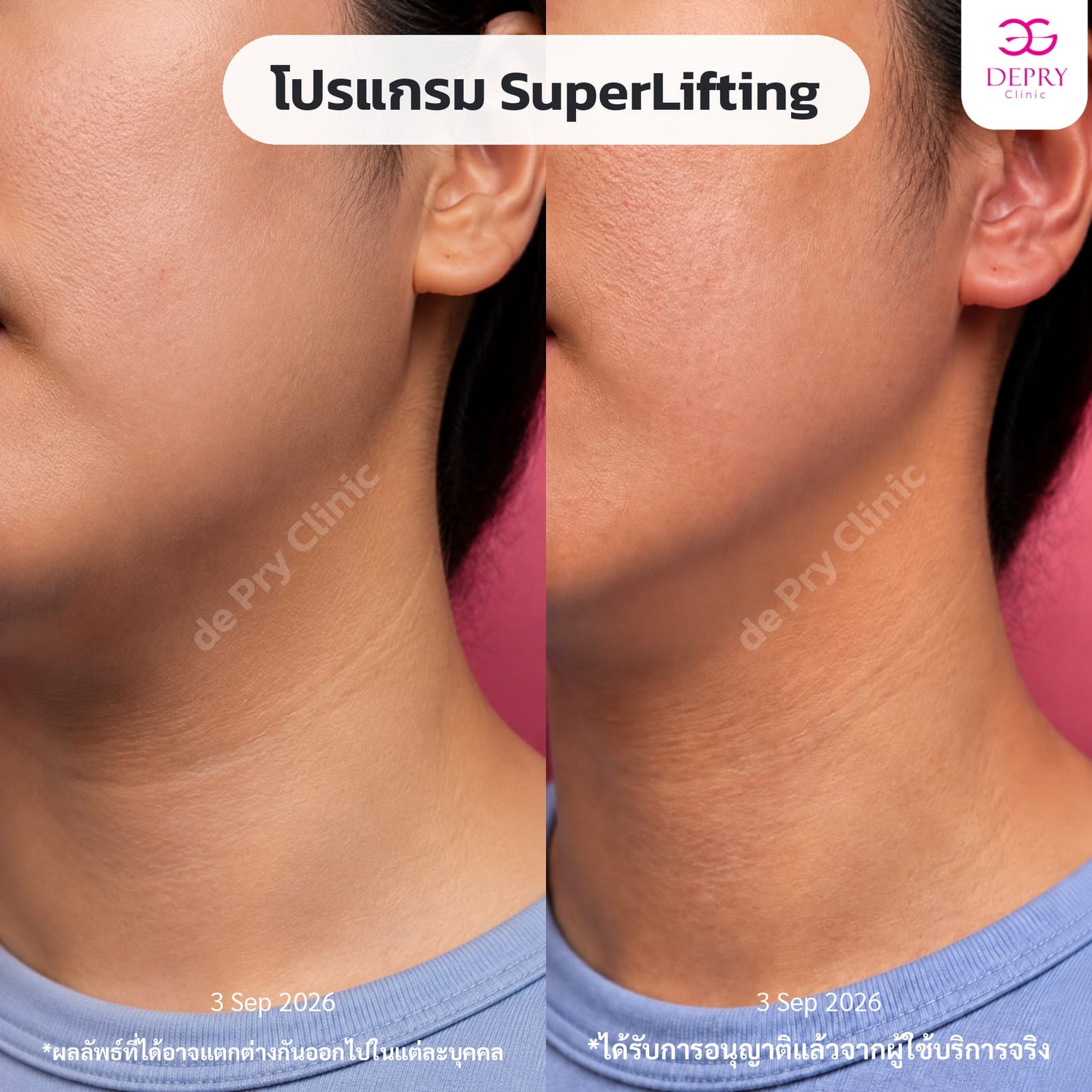 Comparison of the cheeks, jawline, and neck of a SuperLifting program client on September 3, 2026