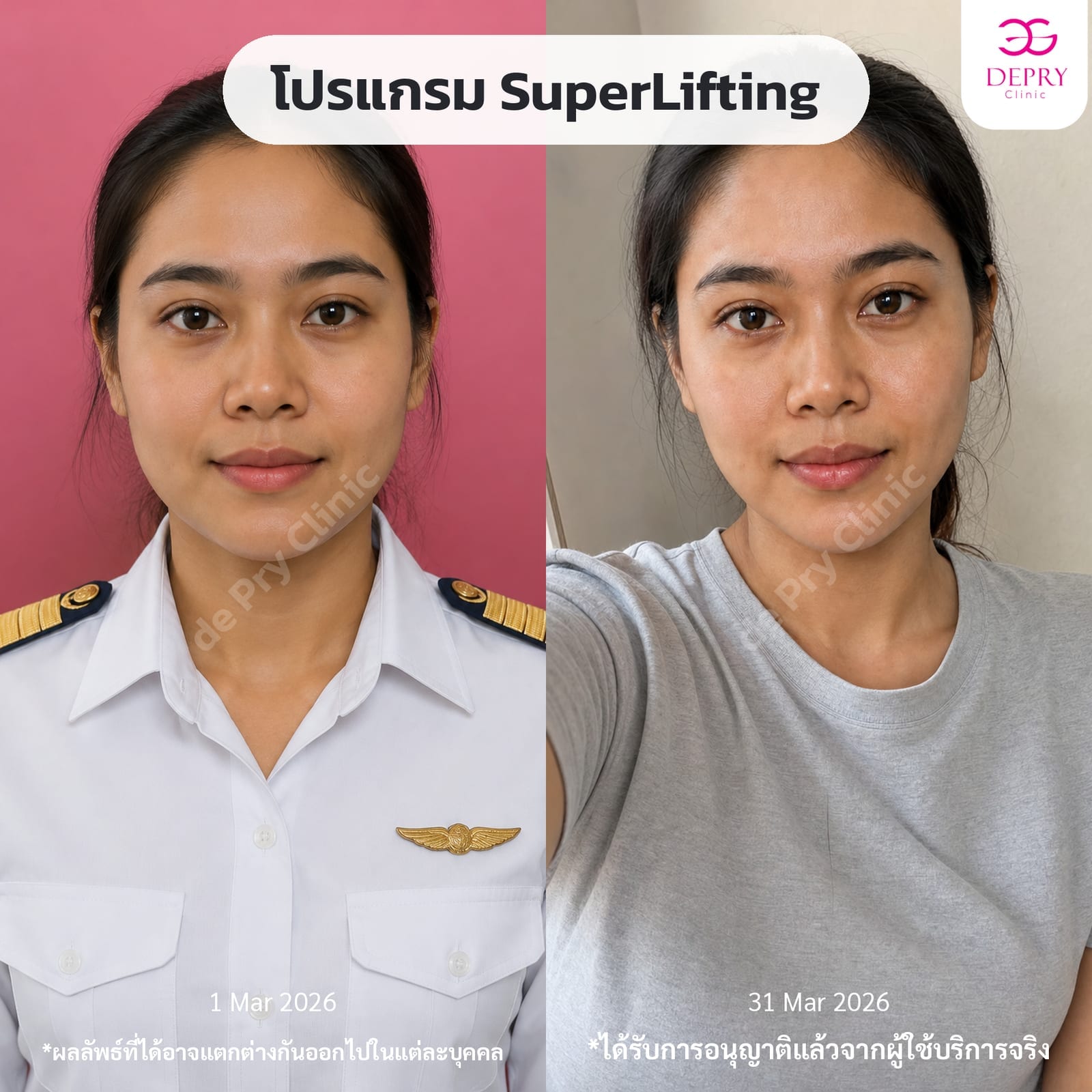Before and after comparison of a female client's face undergoing the SuperLifting program between March 1 and March 31, 2026