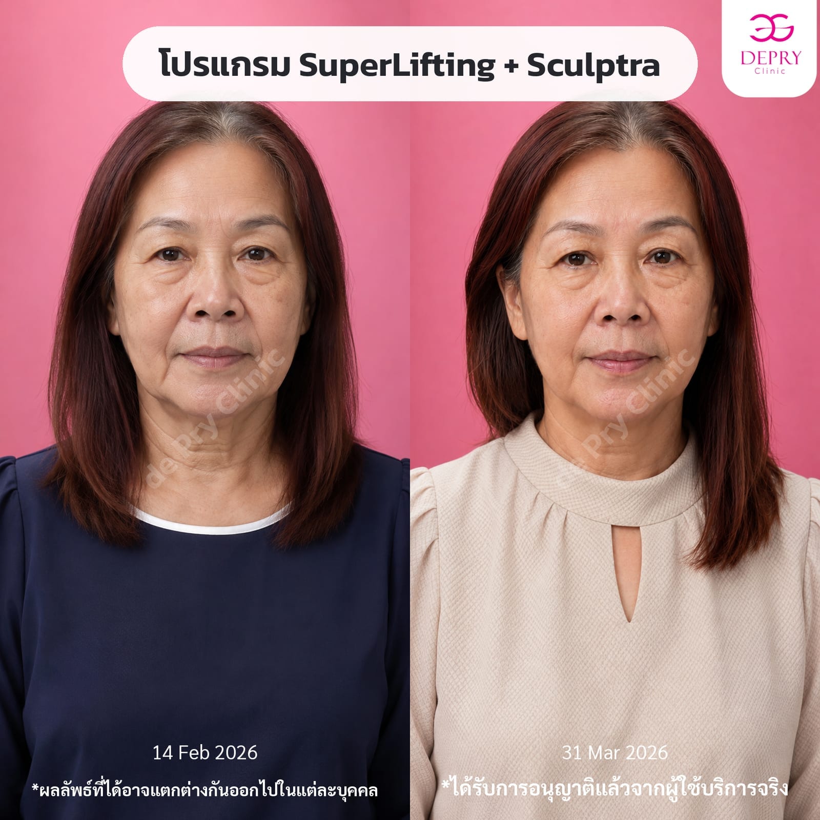 Comparison of a female client's face who combined the SuperLifting program with Sculptra between February 14 and March 31, 2026