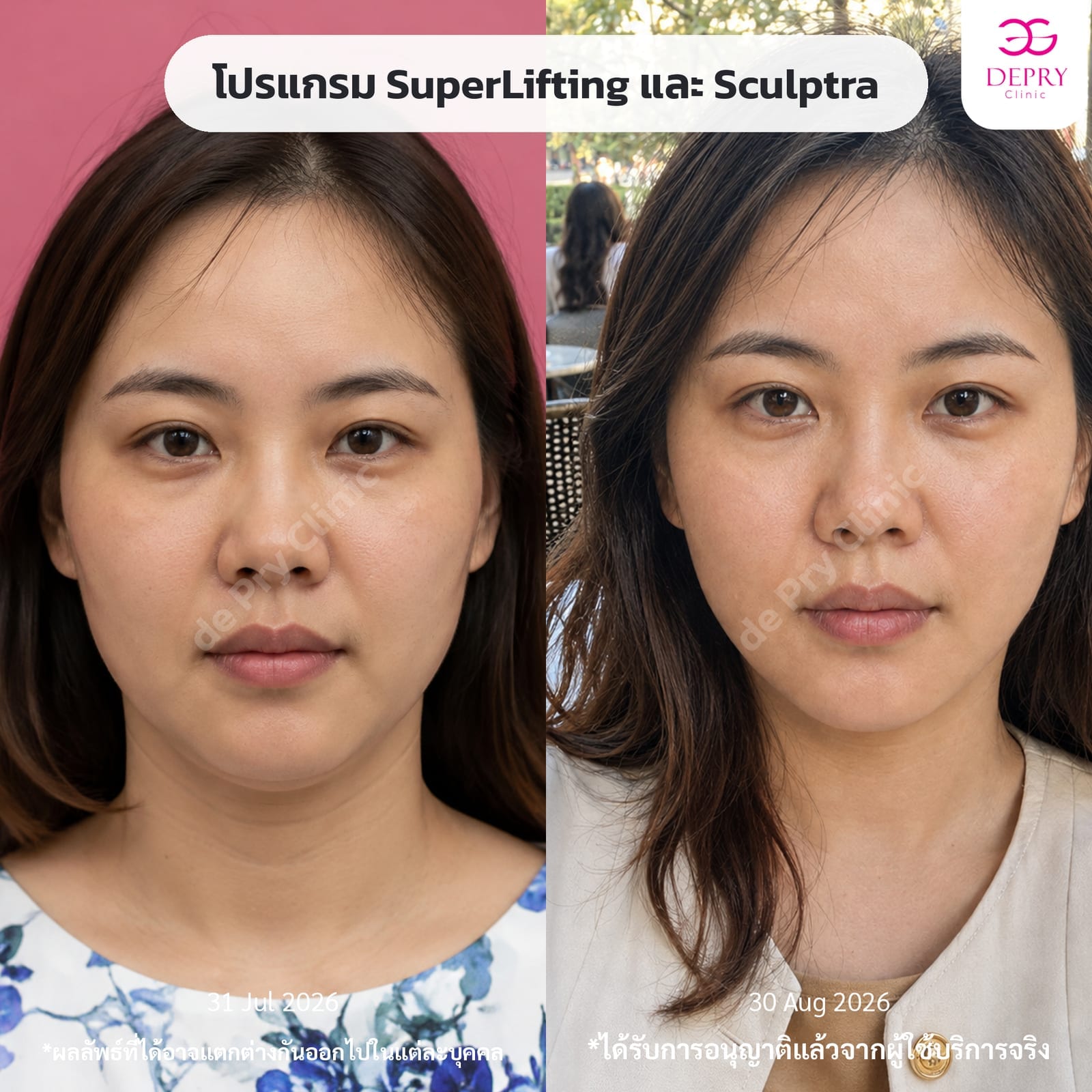 Comparison of a female client's face who combined the SuperLifting program with Sculptra between July 31 and August 30, 2026