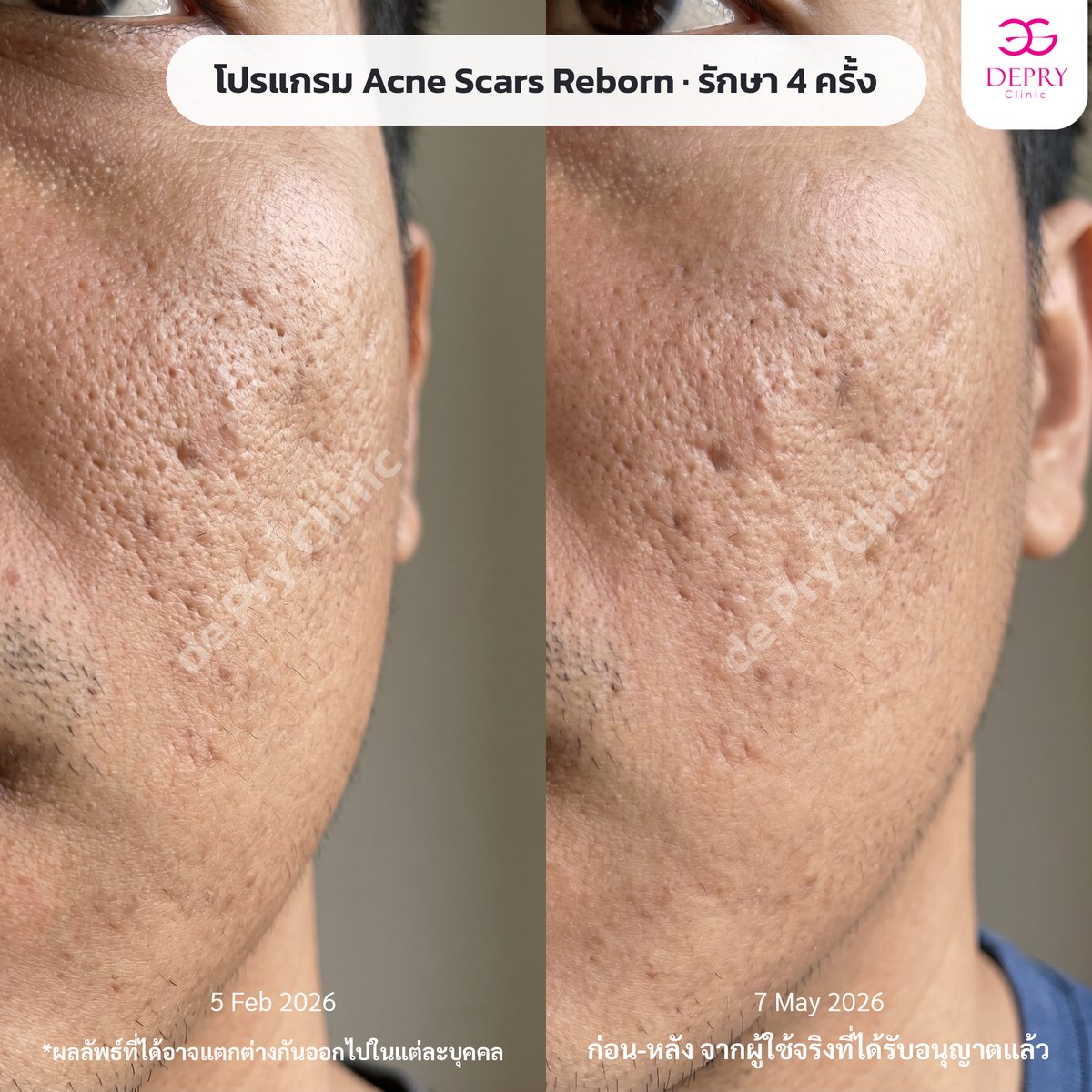 ผลลัพธ์ Acne Scars Reborn รักษา 4 ครั้ง