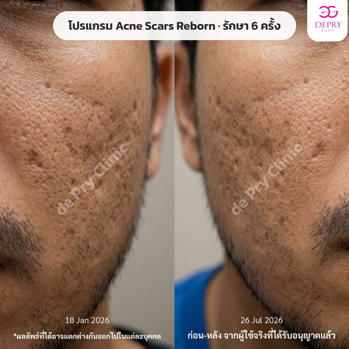ผลลัพธ์ Acne Scars Reborn รักษา 6 ครั้ง