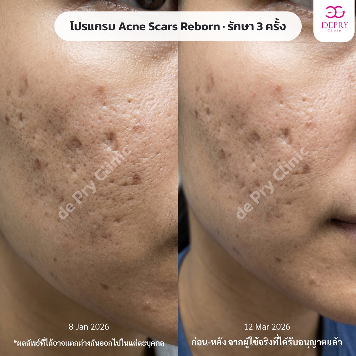 ผลลัพธ์ Acne Scars Reborn รักษา 3 ครั้ง