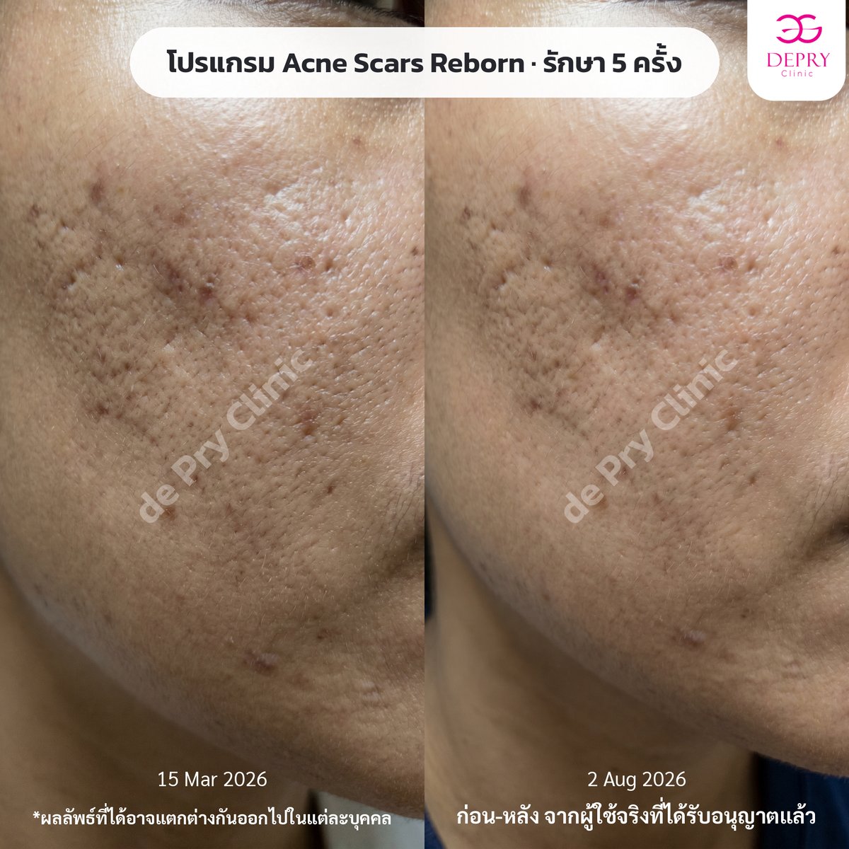 ผลลัพธ์ Acne Scars Reborn รักษา 5 ครั้ง