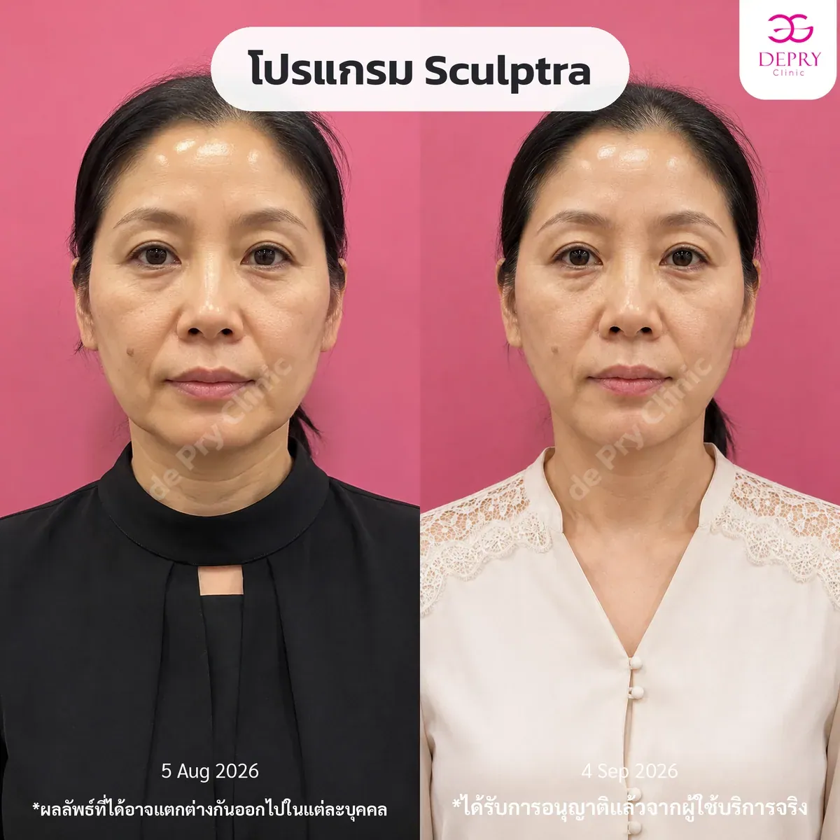 รีวิวผู้ใช้บริการจริง: โปรแกรม Sculptra ก่อน–หลัง — เคสที่ 2