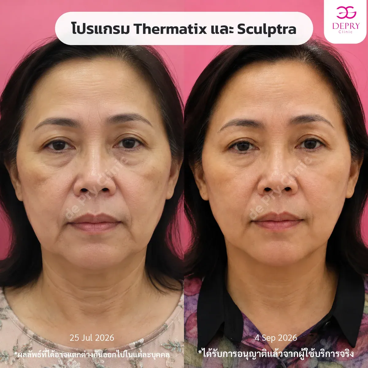 รีวิวผู้ใช้บริการจริง: โปรแกรม Thermatrix และ Sculptra ก่อน–หลัง — เคสที่ 1