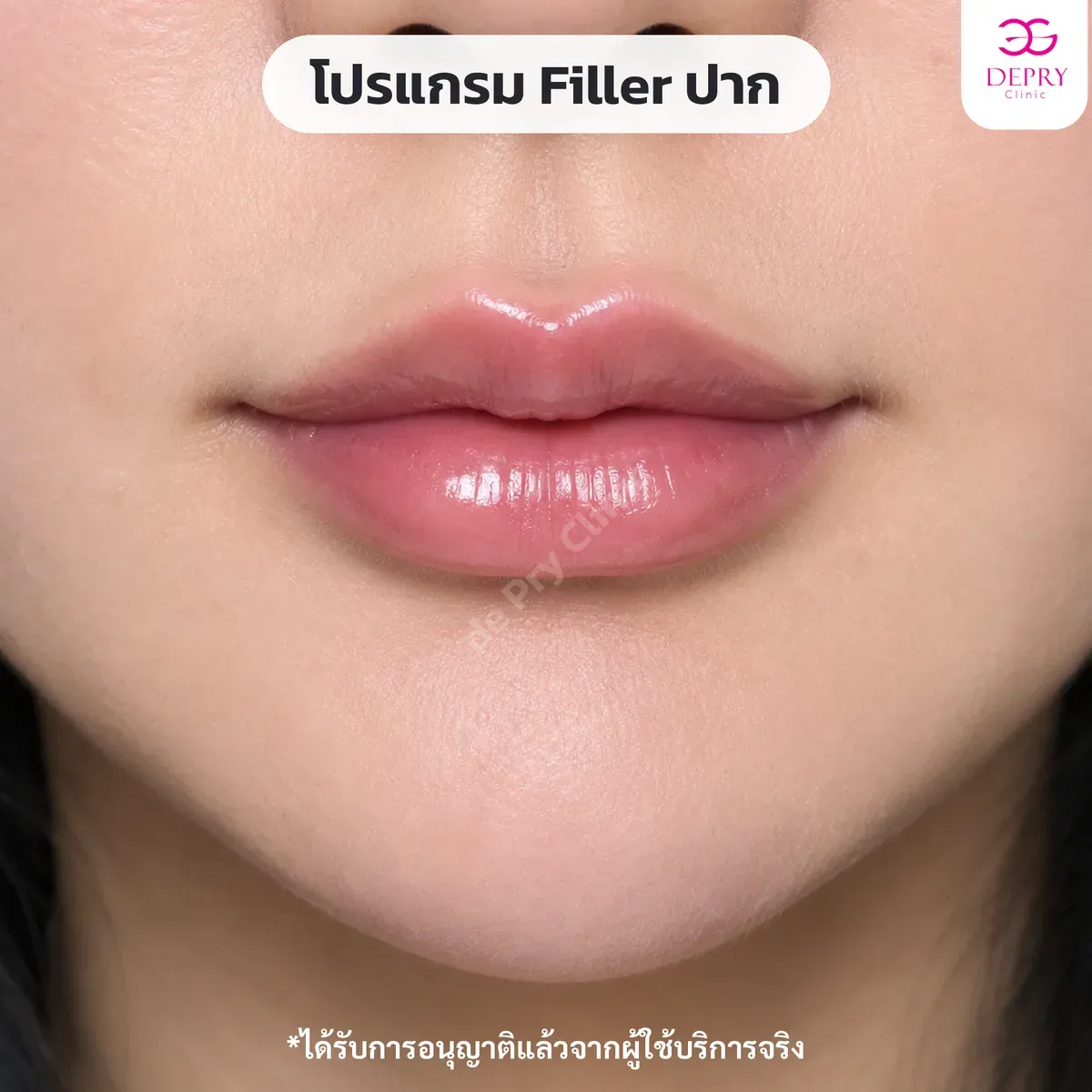 ฟิลเลอร์ปาก