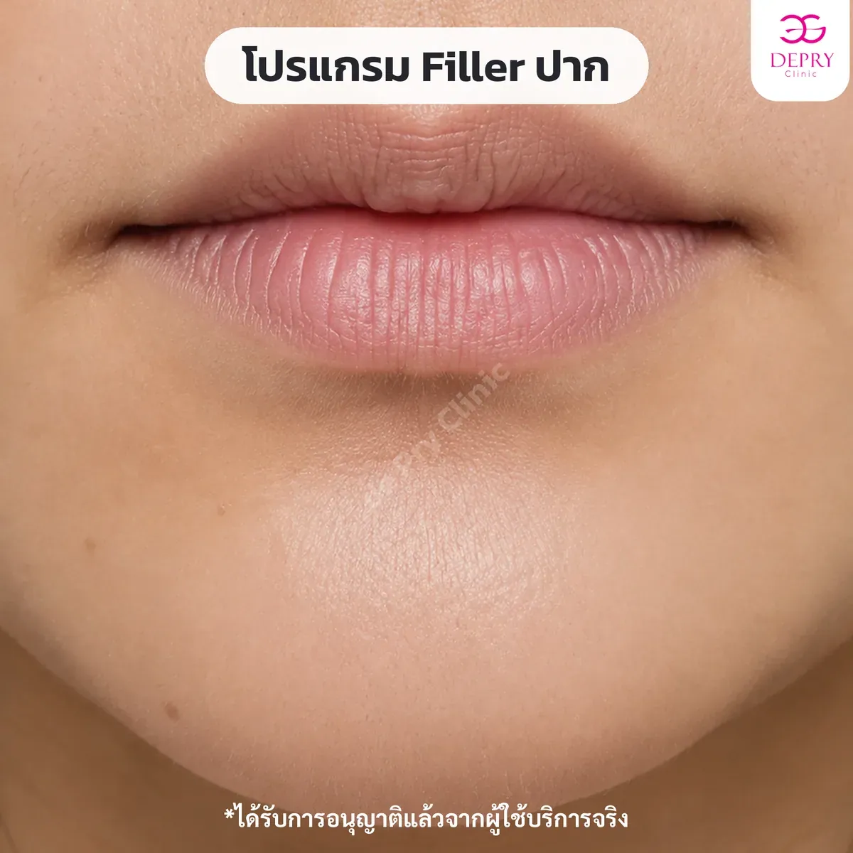 ฟิลเลอร์ปาก