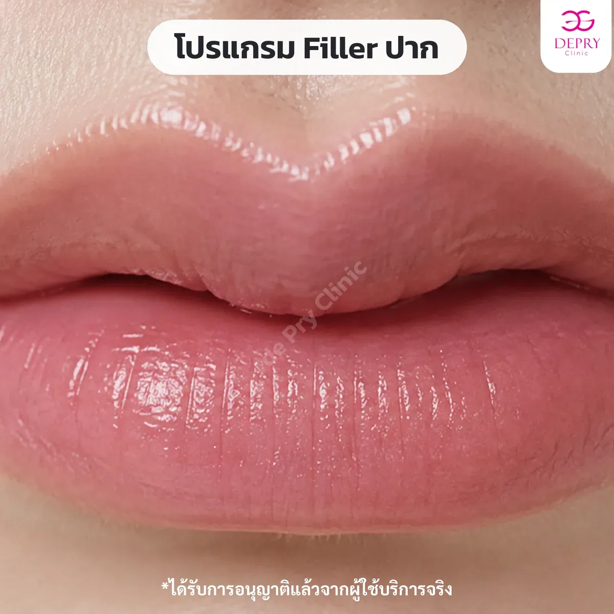 ฟิลเลอร์ปาก