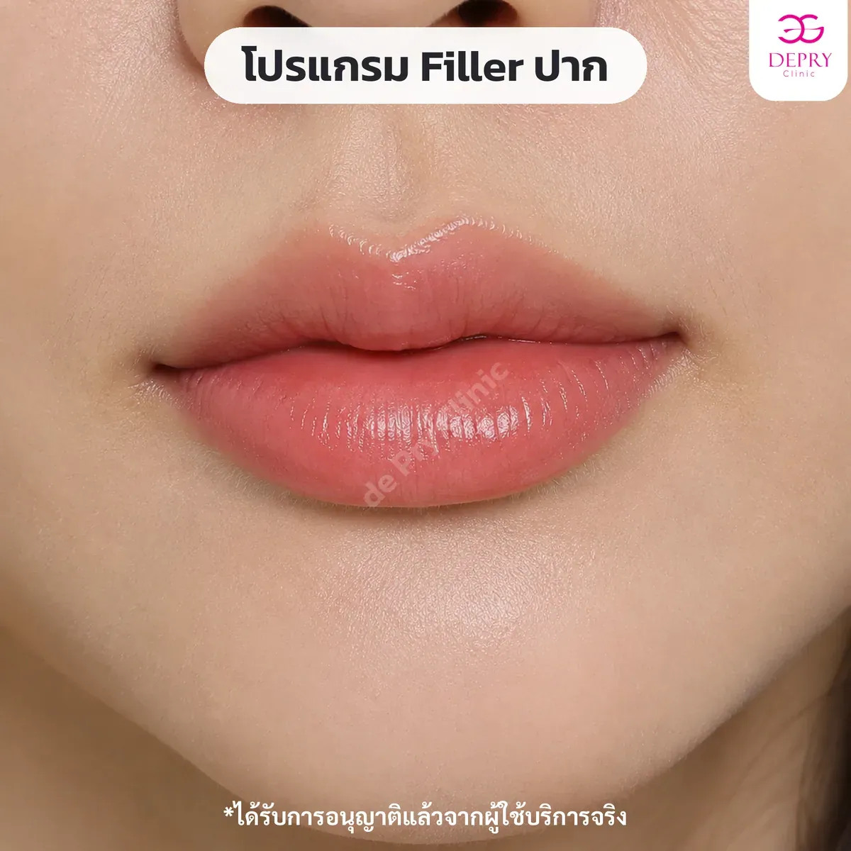 ฟิลเลอร์ปาก