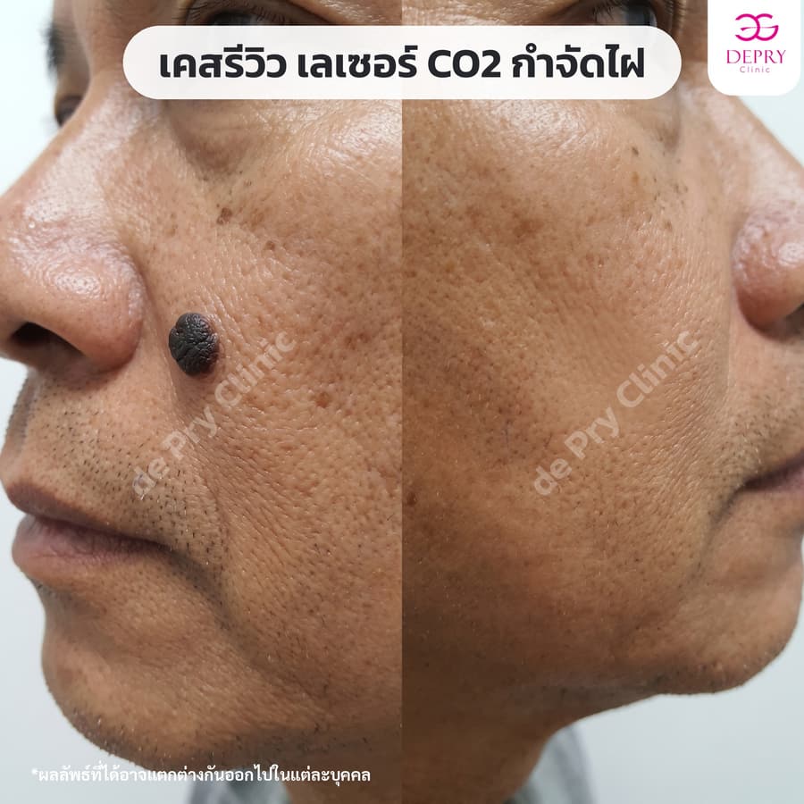 ไฝข้างจมูก ก่อน–หลัง