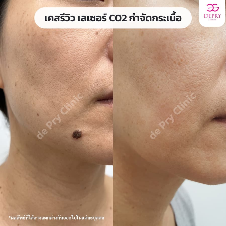 กระเนื้อบริเวณกราม ก่อน–หลัง