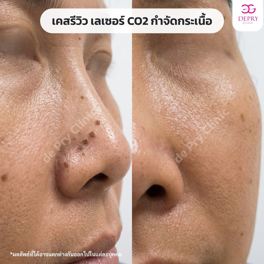 กระเนื้อข้างจมูก ก่อน–หลัง