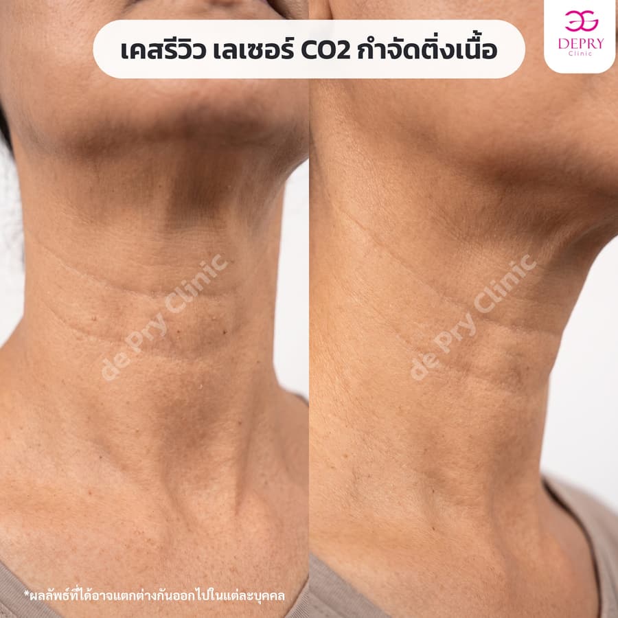 ติ่งเนื้อรอบคอ ก่อน–หลัง