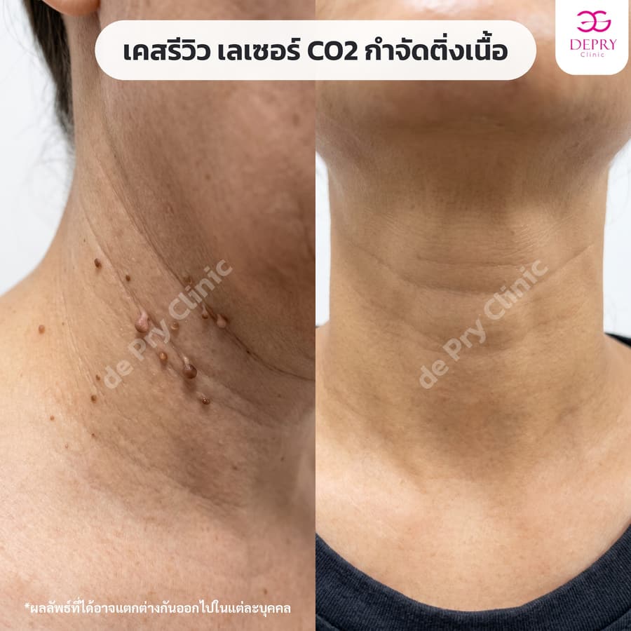 ติ่งเนื้อรอบคอ ก่อน–หลัง
