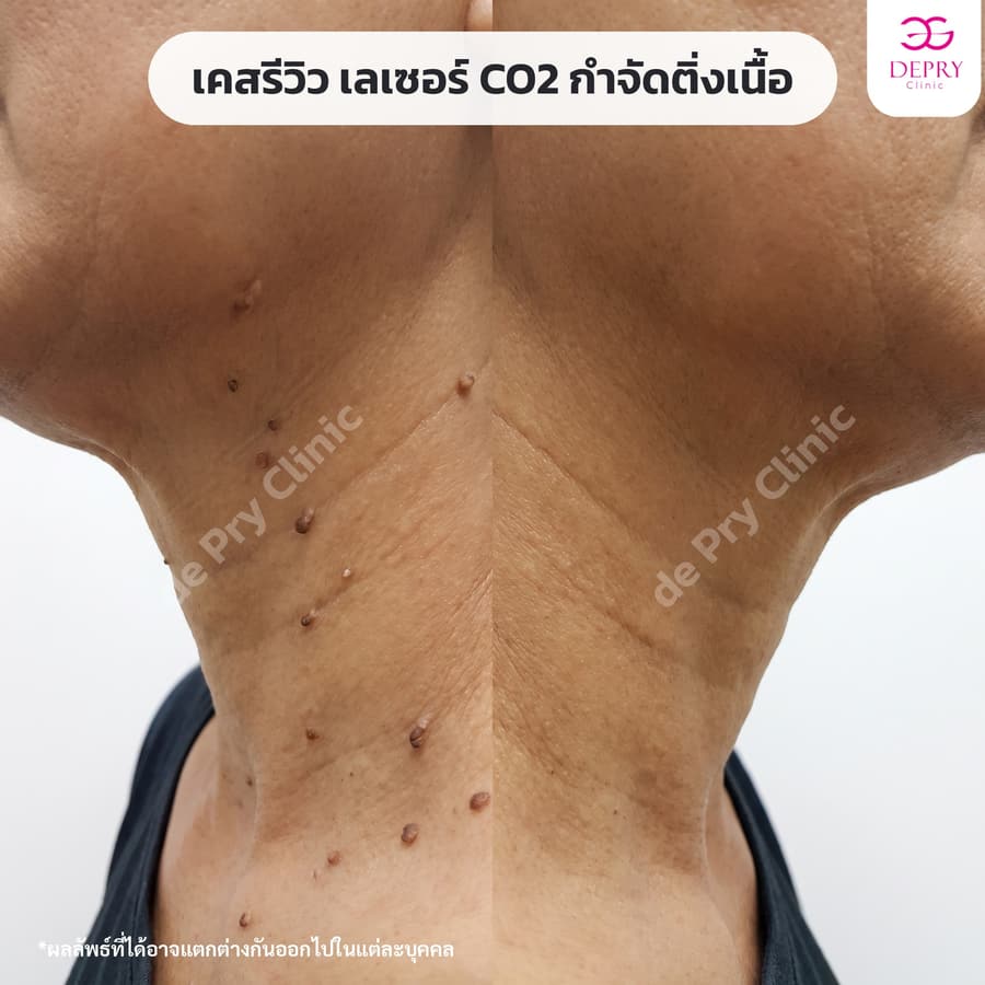 ติ่งเนื้อรอบคอ (ขึ้นหนาแน่น) ก่อน–หลัง