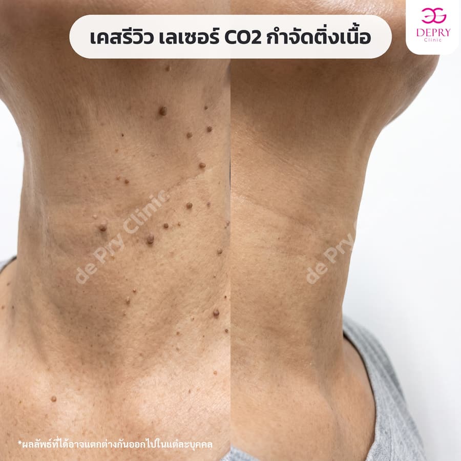ติ่งเนื้อรอบคอ ก่อน–หลัง