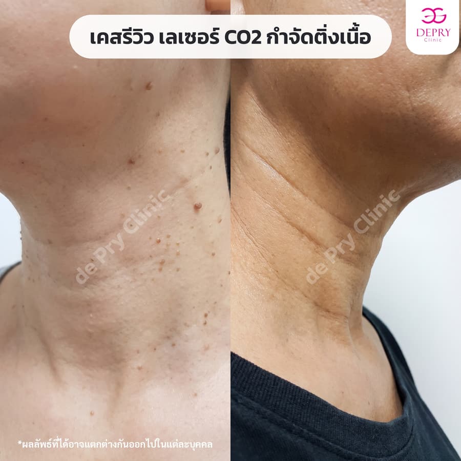 ติ่งเนื้อรอบคอ ก่อน–หลัง