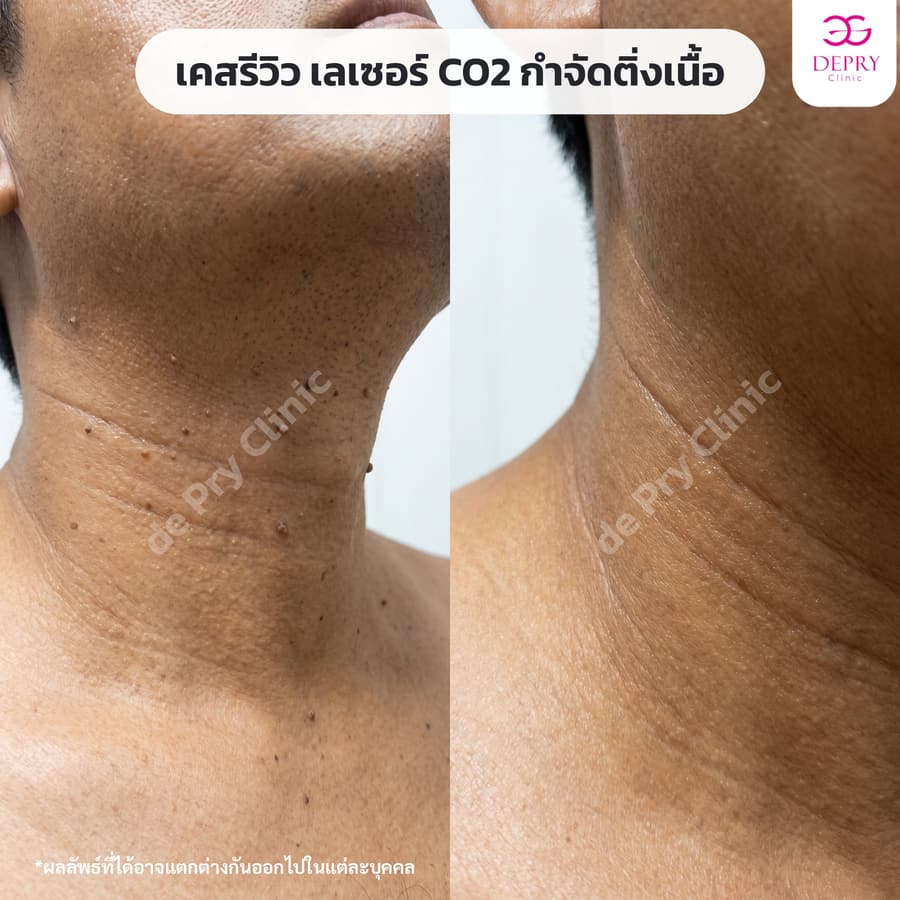 ติ่งเนื้อรอบคอ ก่อน–หลัง