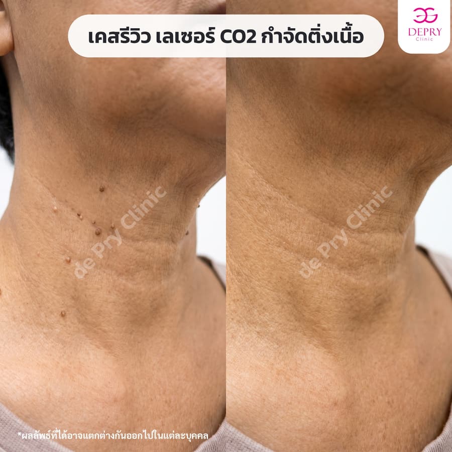 ติ่งเนื้อรอบคอ ก่อน–หลัง