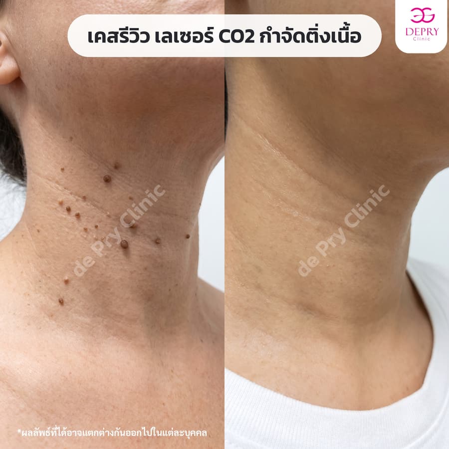 ติ่งเนื้อรอบคอ ก่อน–หลัง