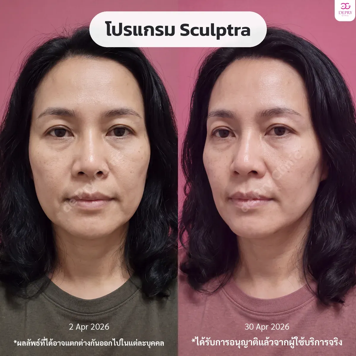 รีวิวผู้ใช้บริการจริง: โปรแกรม Sculptra ก่อน–หลัง — เคสที่ 3