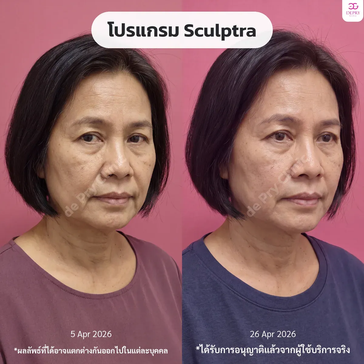 รีวิวผู้ใช้บริการจริง: โปรแกรม Sculptra ก่อน–หลัง — เคสที่ 4