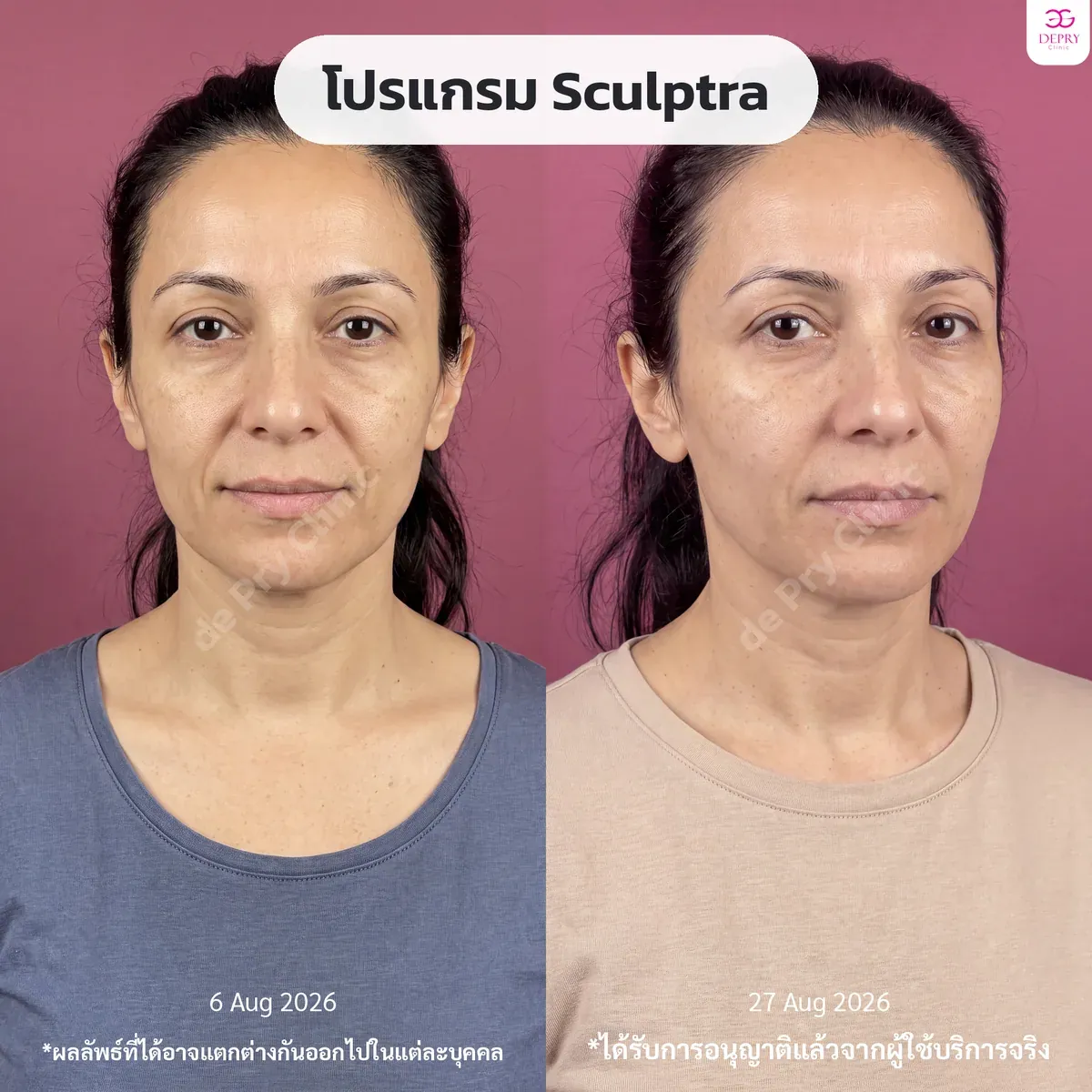 รีวิวผู้ใช้บริการจริง: โปรแกรม Sculptra ก่อน–หลัง — เคสที่ 5