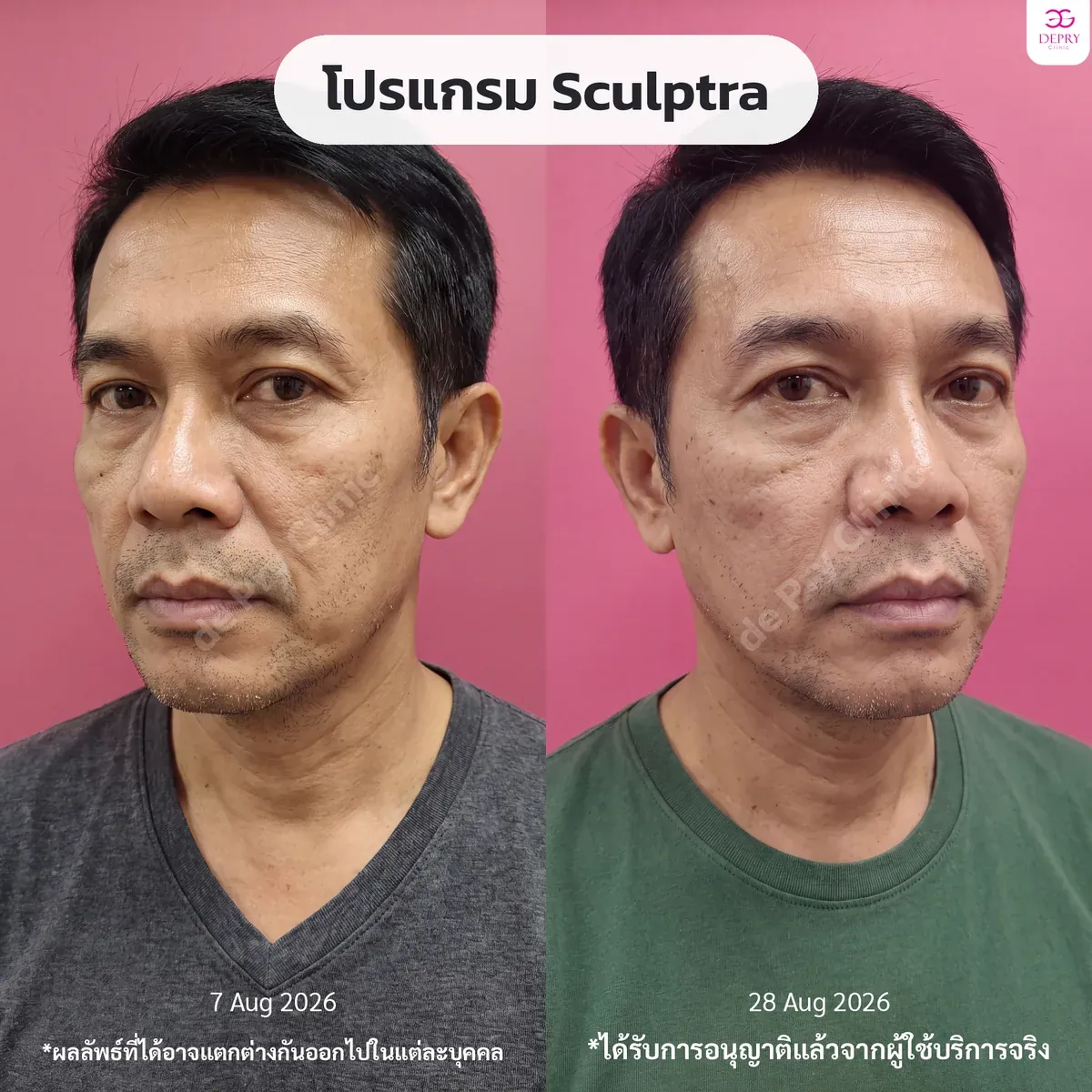 รีวิวผู้ใช้บริการจริง: โปรแกรม Sculptra ก่อน–หลัง — เคสที่ 6