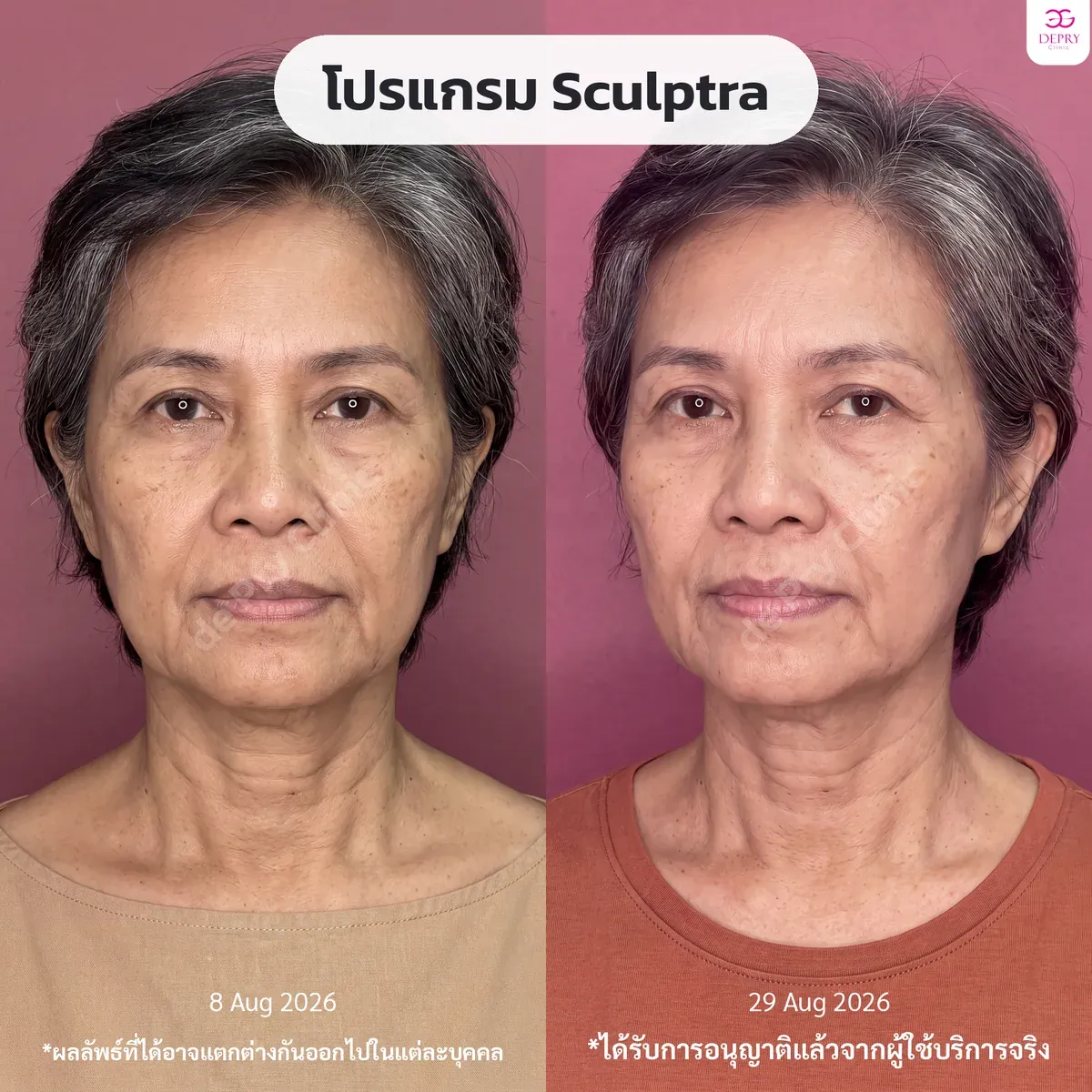 รีวิวผู้ใช้บริการจริง: โปรแกรม Sculptra ก่อน–หลัง — เคสที่ 7