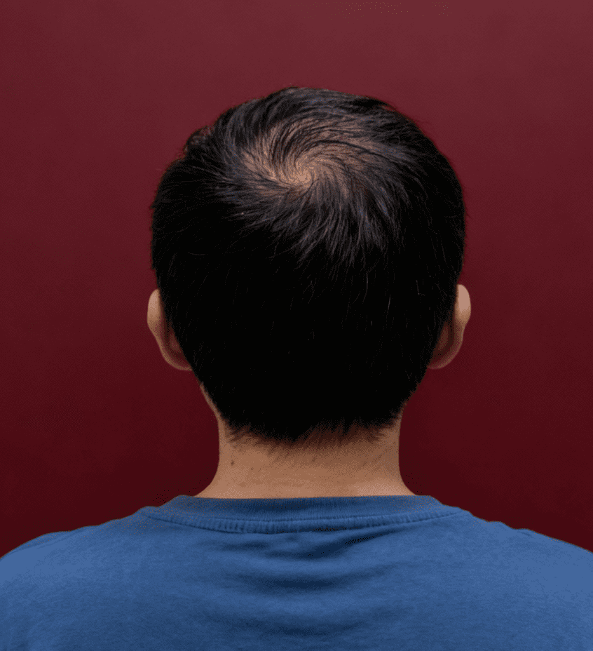 ExoHair After Treatment Case 2