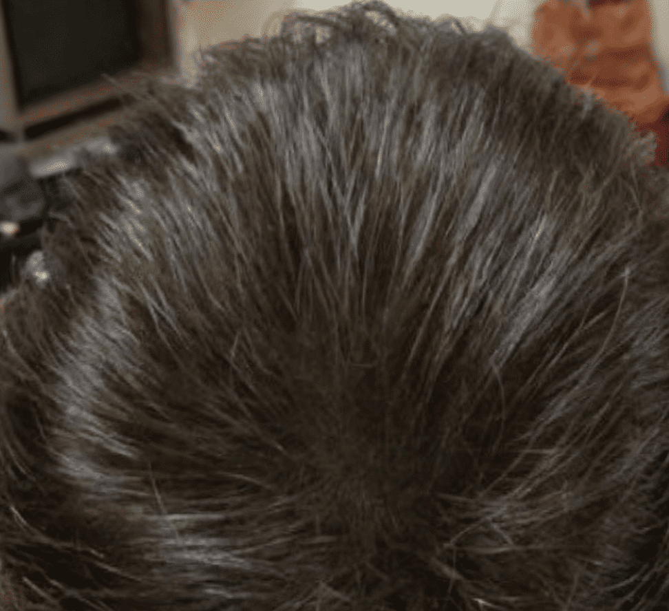 ExoHair After Treatment Case 1