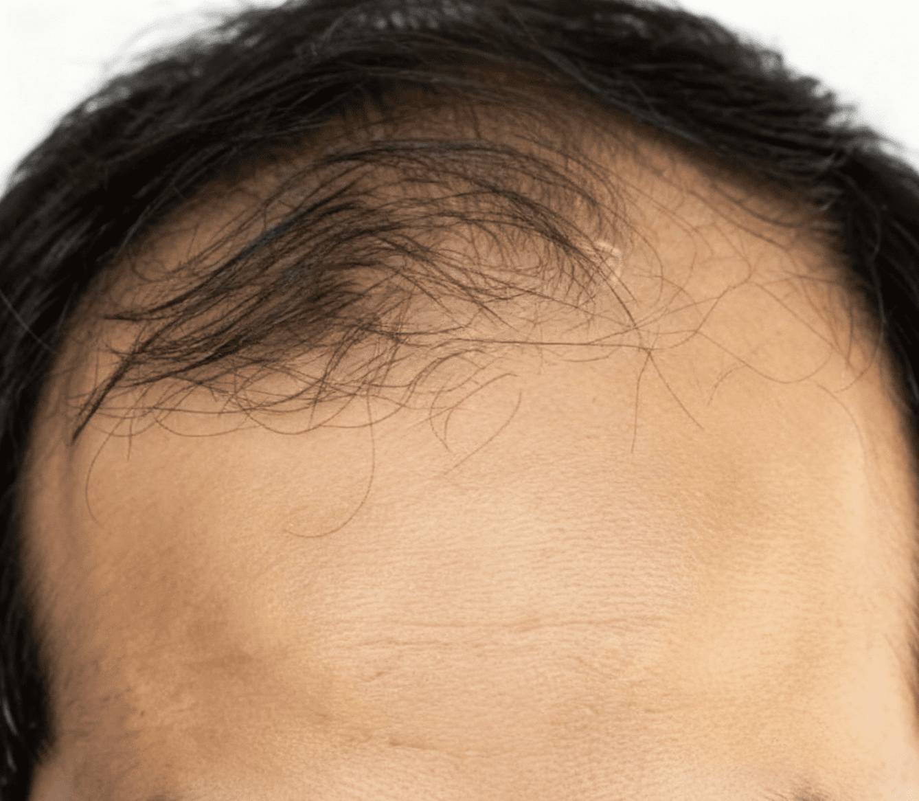 ExoHair After Treatment Case 3