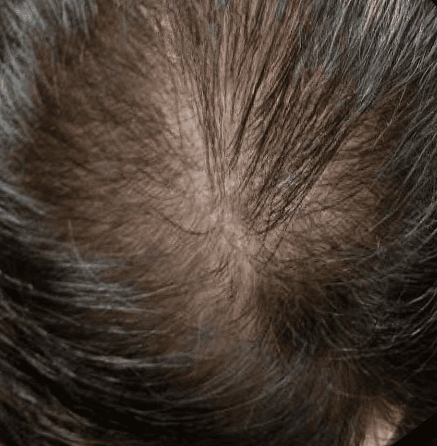 ExoHair Before Treatment Case 1